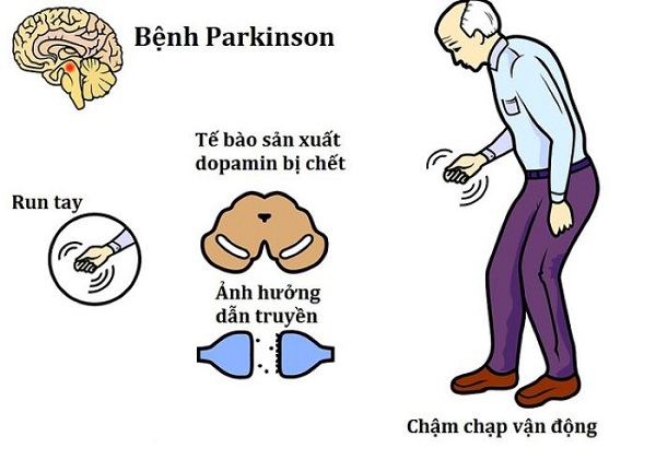 PQA Thư Can Dưỡng Huyết – Giải Pháp Toàn Diện Cho Người Bị Parkinson
